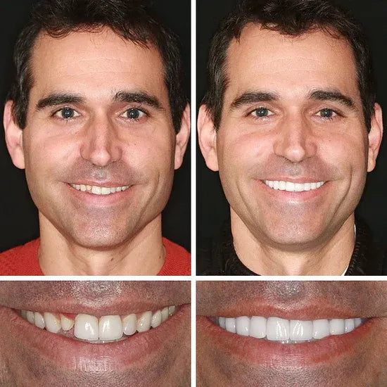 ⏰ Ends Today: 50% OFF! 🌎 KLENIMORE™ Daily Smile Confidence Set — Natural Look, Easy Everyday Wear